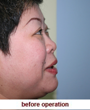 plastic_surgery_augmentation_rhinoplasty